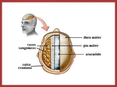 Meningite