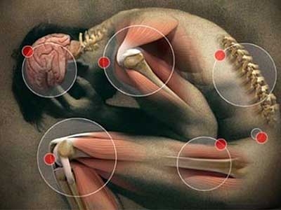 Fibromialgia 