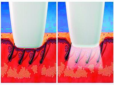 Depilação a laser é diferente de  luz pulsada