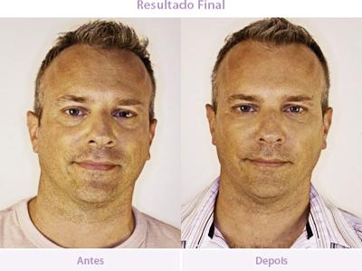 Peeling e preenchimento são  aliados da beleza e bem-estar