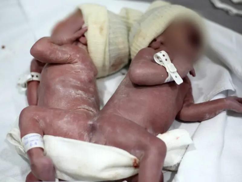 Gêmeos siameses nascem em hospital de Campo Largo; médica revela que caso é ainda mais raro